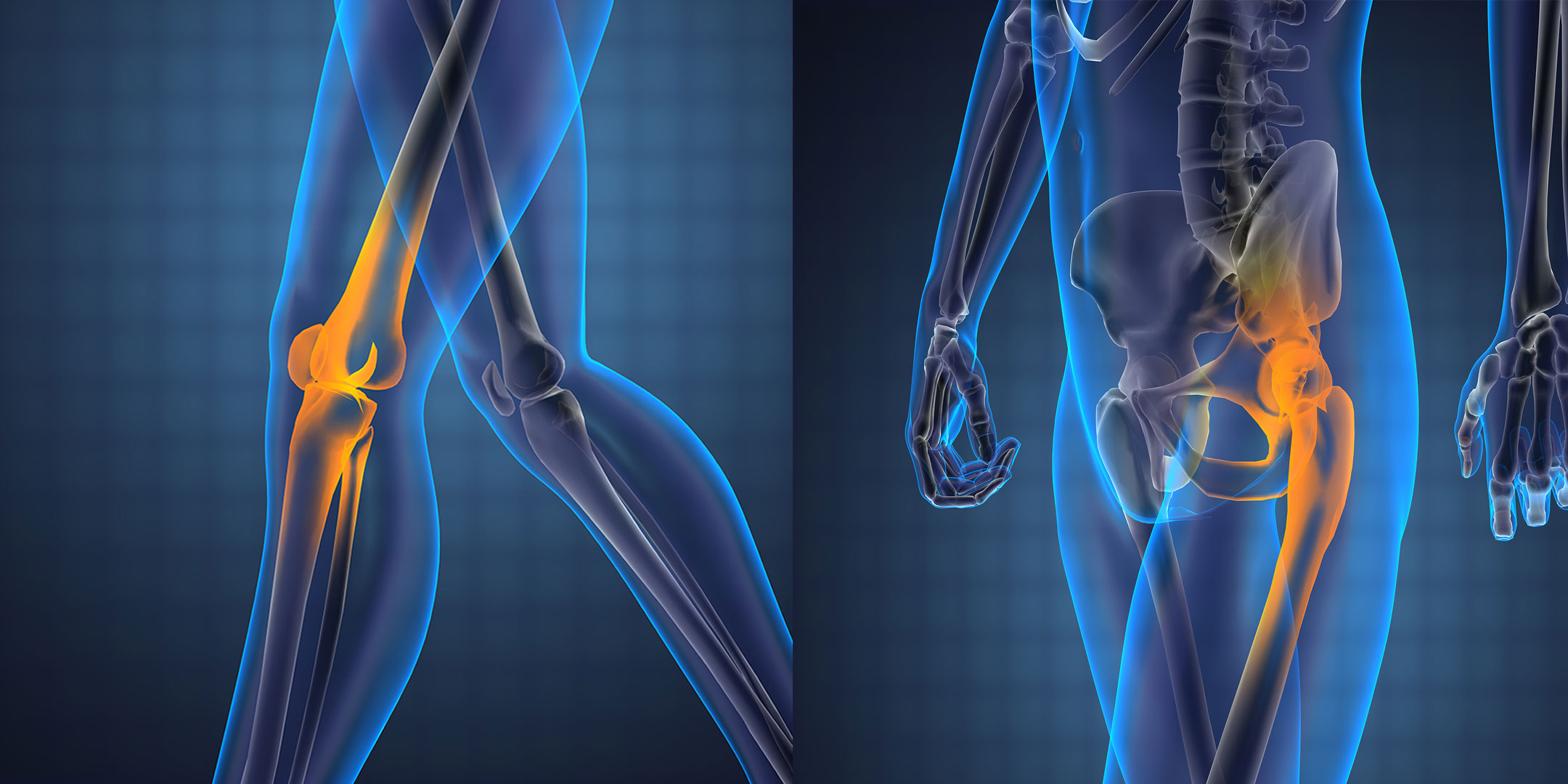 Joint Replacement